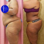 African American Tummy Tuck (Abdominoplasty) Before & After Patient #14585