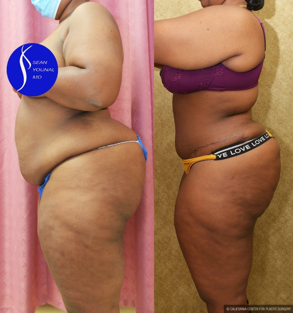 African American Tummy Tuck (Abdominoplasty) Before & After Patient #14585