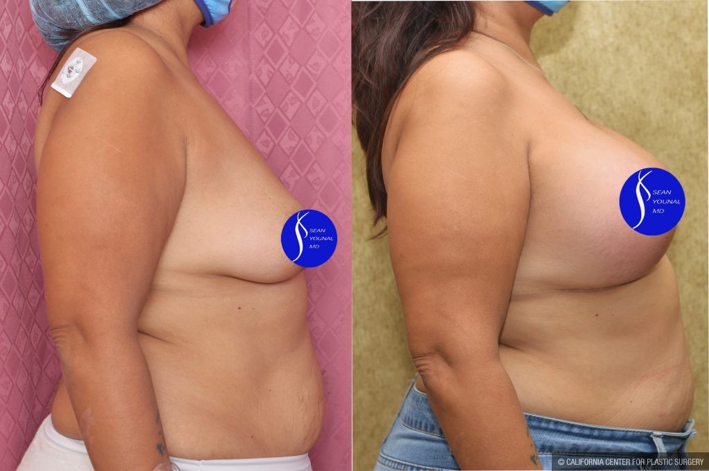 Breast Lift - Full Before & After Patient #14587