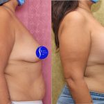 Breast Lift - Full Before & After Patient #14587