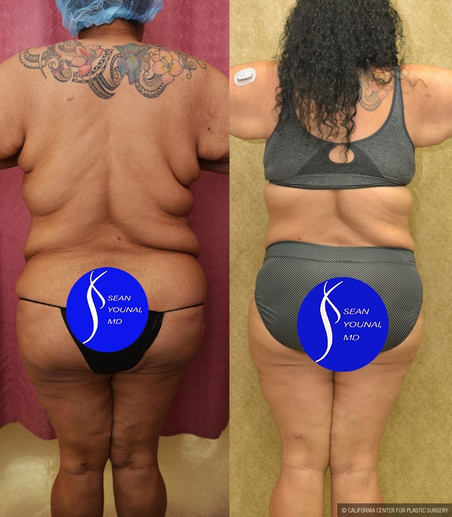 Tummy Tuck (Abdominoplasty) Super Plus Size Before & After Patient #14577