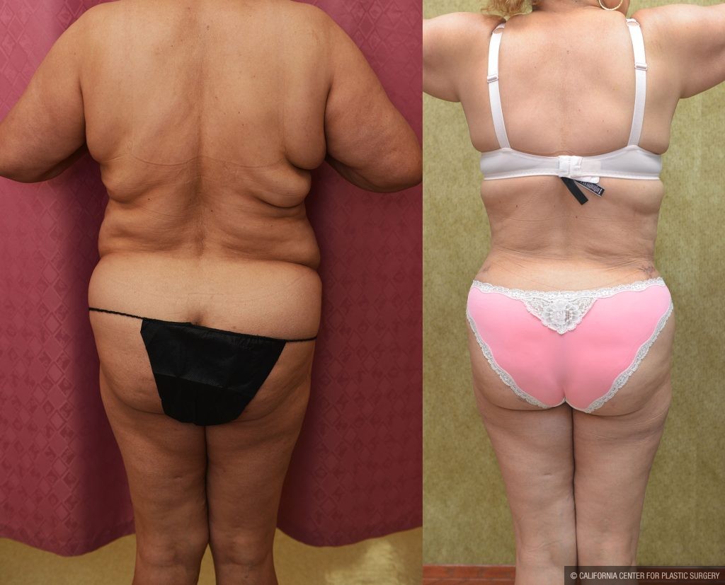 Tummy Tuck (Abdominoplasty) Super Plus Size Before & After Patient #14575