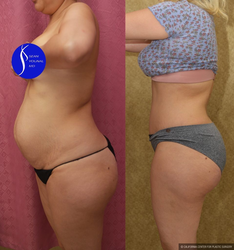 Tummy Tuck (Abdominoplasty) Small Size Before & After Patient #14579