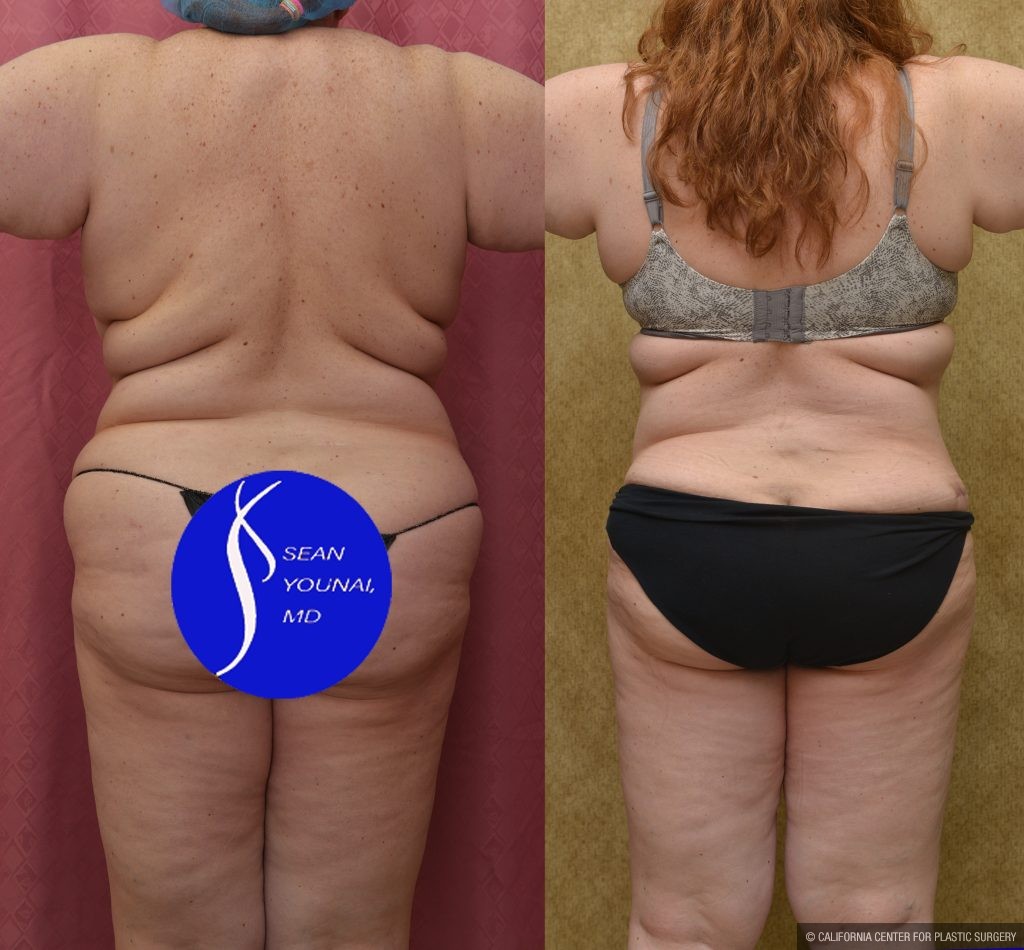 Tummy Tuck (Abdominoplasty) Plus Size Before & After Patient #14580