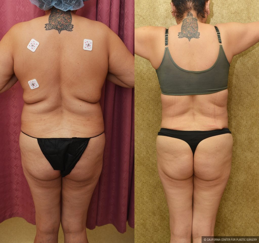 Tummy Tuck (Abdominoplasty) Medium Size Before & After Patient #14583