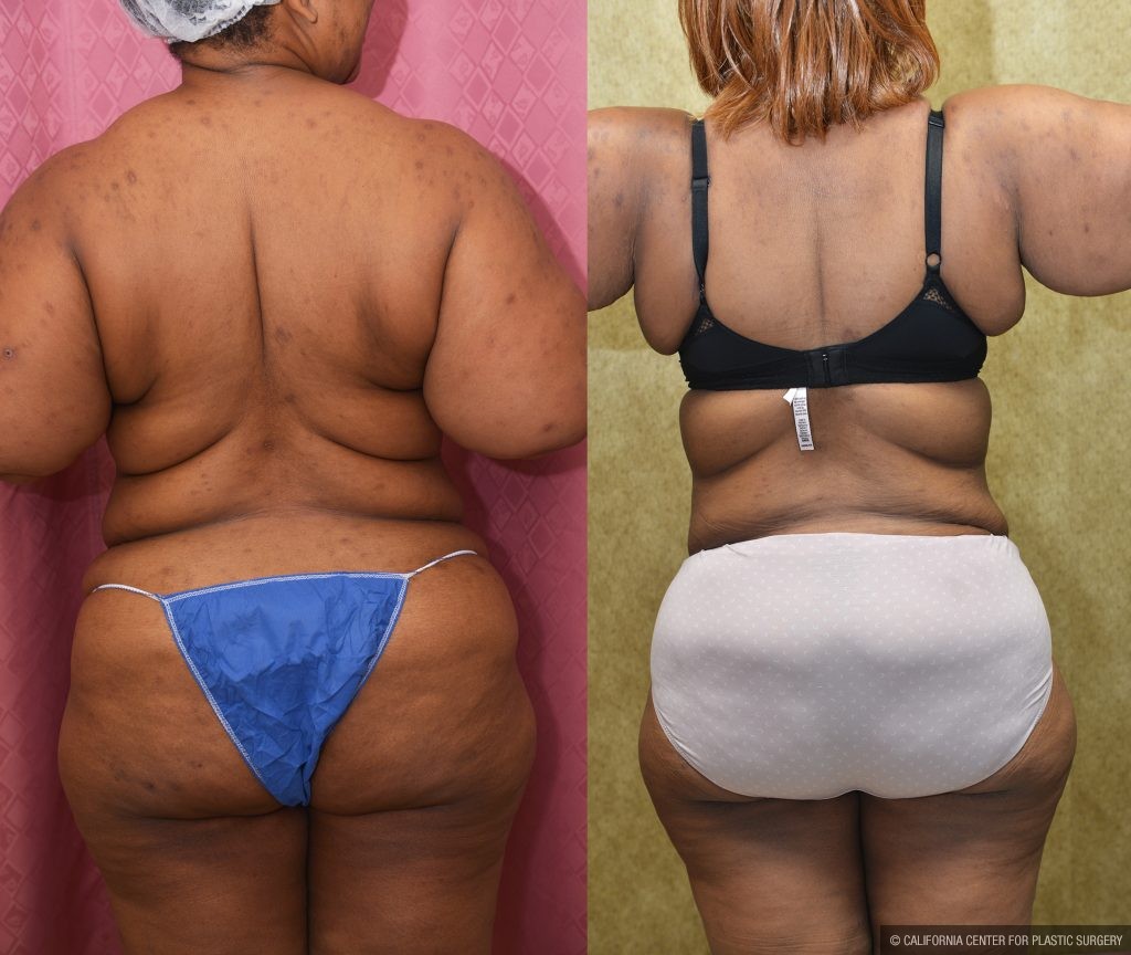 Tummy Tuck (Abdominoplasty) Plus Size Before & After Patient #14584