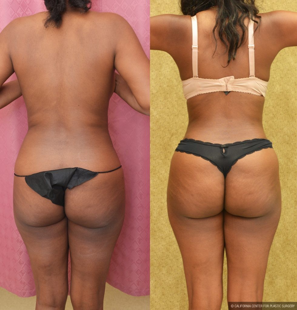 Tummy Tuck (Abdominoplasty) Small Size Before & After Patient #14590