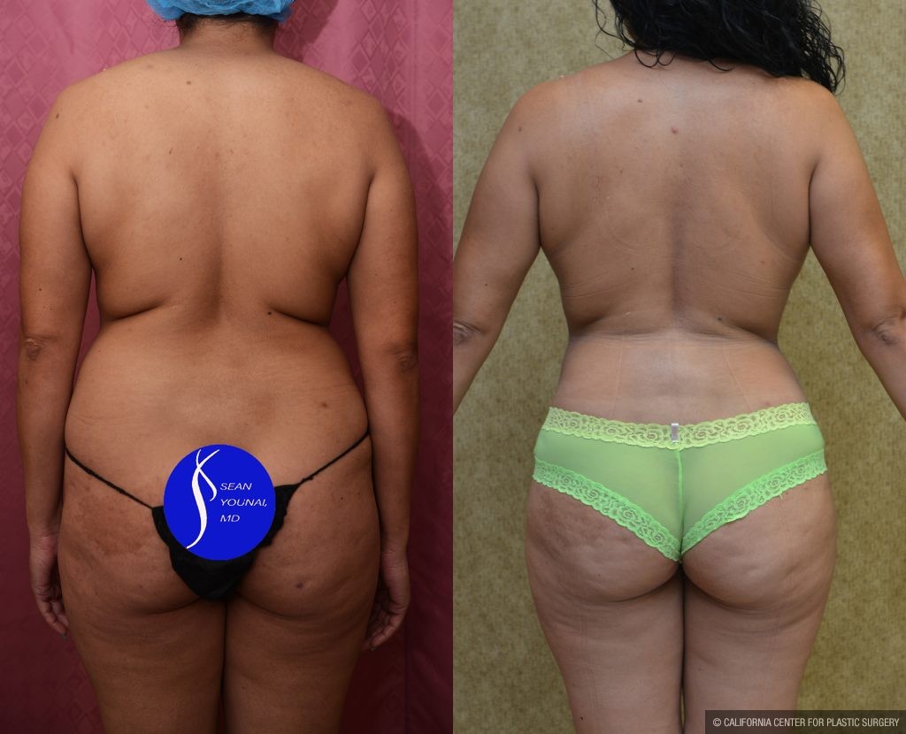Mommy Makeover Before & After Patient #14593