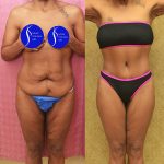 Body Lift Before & After Patient #14689