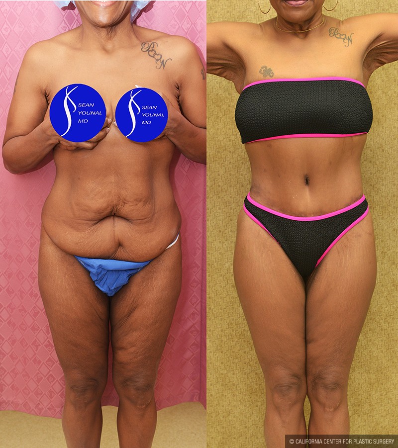Body Lift Before & After Patient #14689
