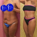 Body Lift Before & After Patient #14689