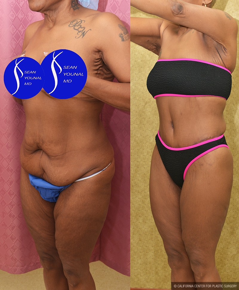 Body Lift Before & After Patient #14689