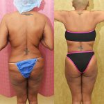 Body Lift Before & After Patient #14689