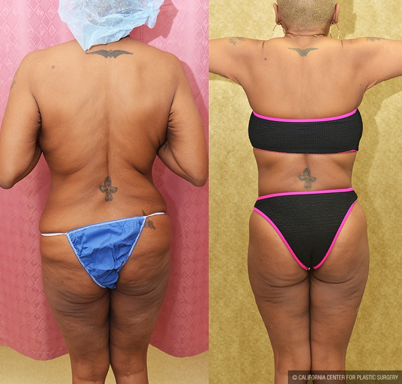 Body Lift Before & After Patient #14689