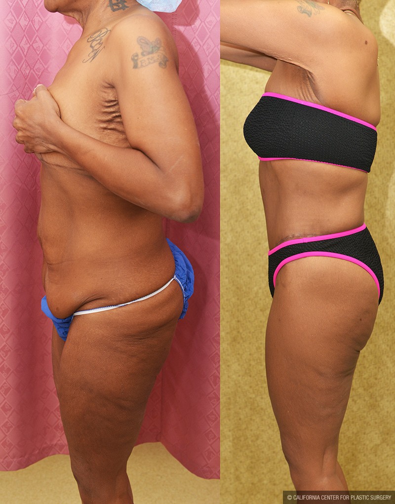 Body Lift Before & After Patient #14689