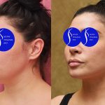 Neck & Face Liposuction Before & After Patient #14690