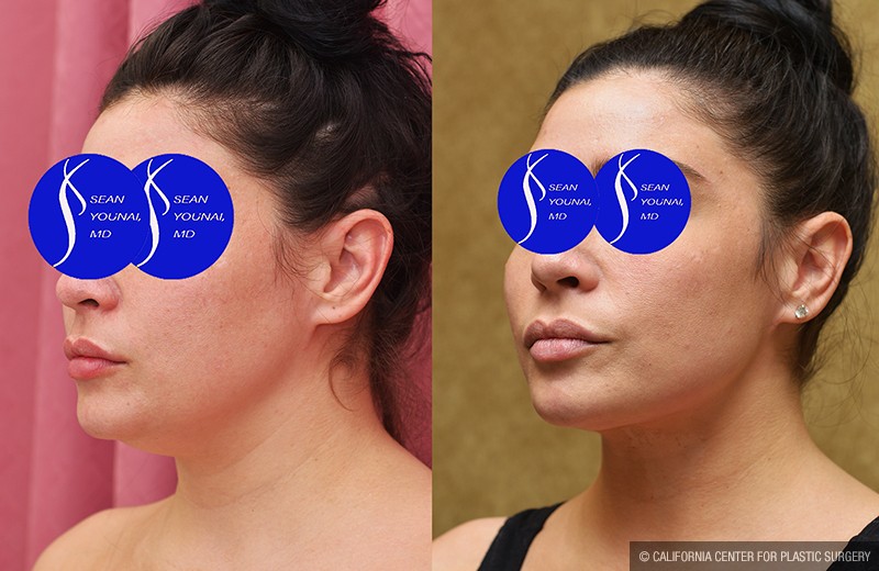 Neck & Face Liposuction Before & After Patient #14690