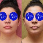 Neck & Face Liposuction Before & After Patient #14690