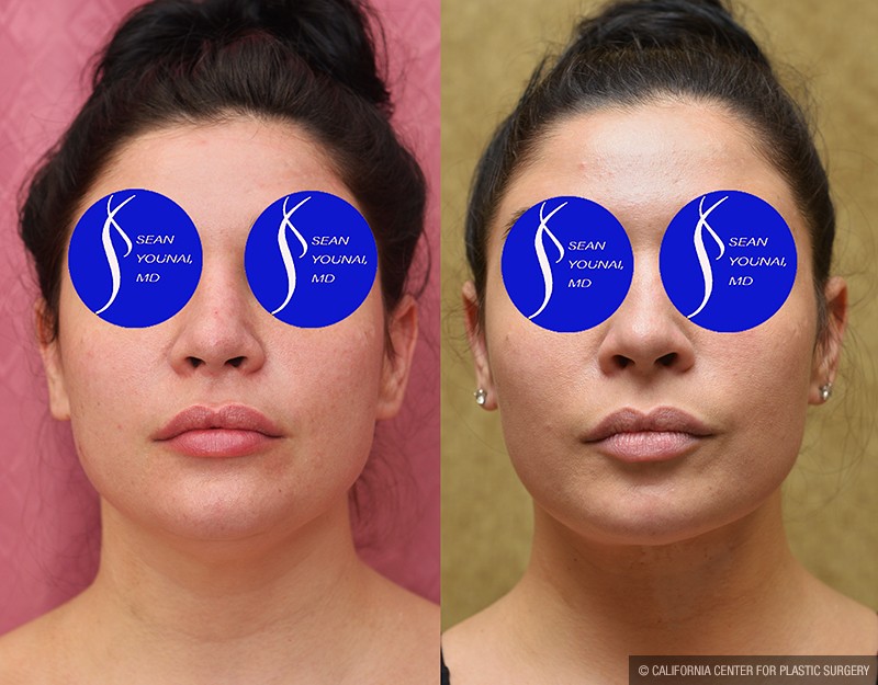 Neck & Face Liposuction Before & After Patient #14690