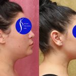 Neck & Face Liposuction Before & After Patient #14690