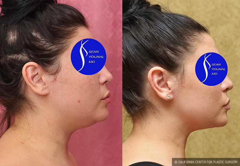 Neck & Face Liposuction Before & After Patient #14690