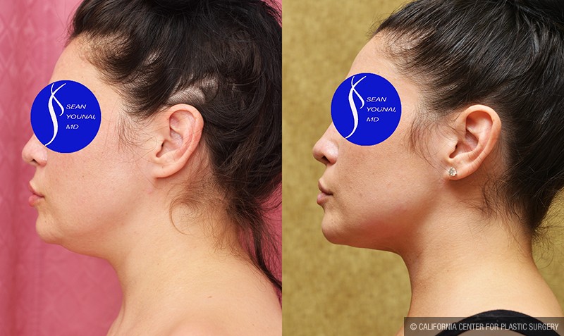 Neck & Face Liposuction Before & After Patient #14690