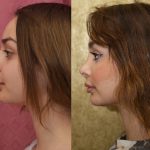 Rhinoplasty - Caucasian Before & After Patient #14694