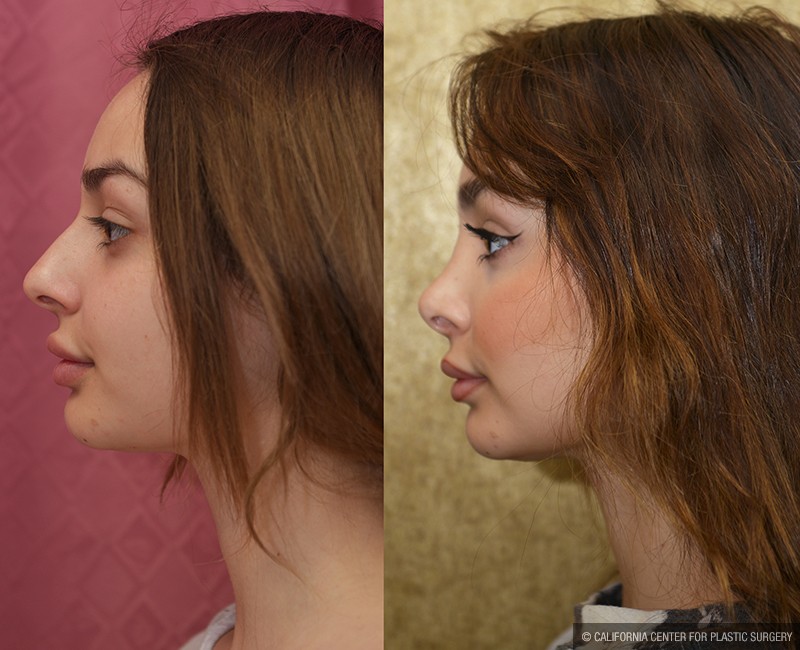 Rhinoplasty - Caucasian Before & After Patient #14694