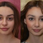 Rhinoplasty - Caucasian Before & After Patient #14694