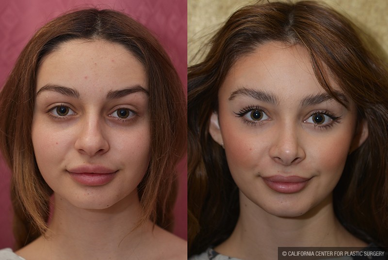 Rhinoplasty - Caucasian Before & After Patient #14694