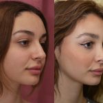 Rhinoplasty - Caucasian Before & After Patient #14694