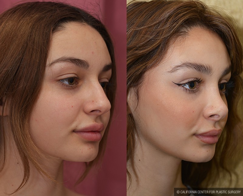 Rhinoplasty - Caucasian Before & After Patient #14694
