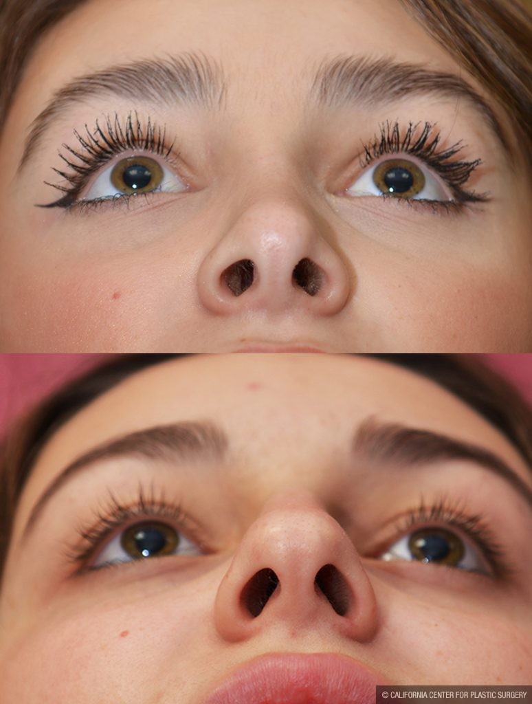 Rhinoplasty - Caucasian Before & After Patient #14694