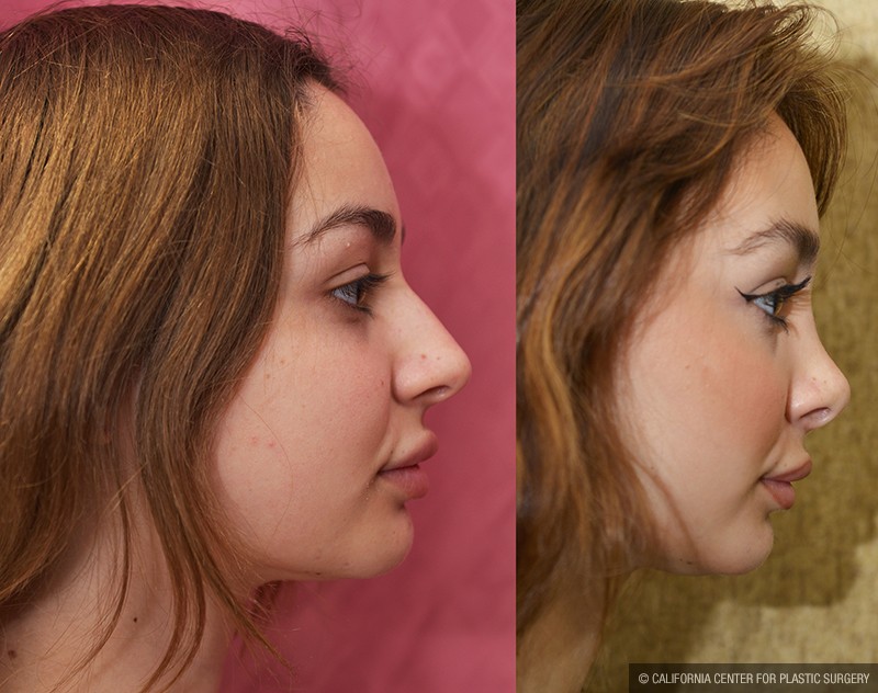 Rhinoplasty - Caucasian Before & After Patient #14694
