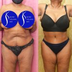 African American Tummy Tuck (Abdominoplasty) Before & After Patient #14695