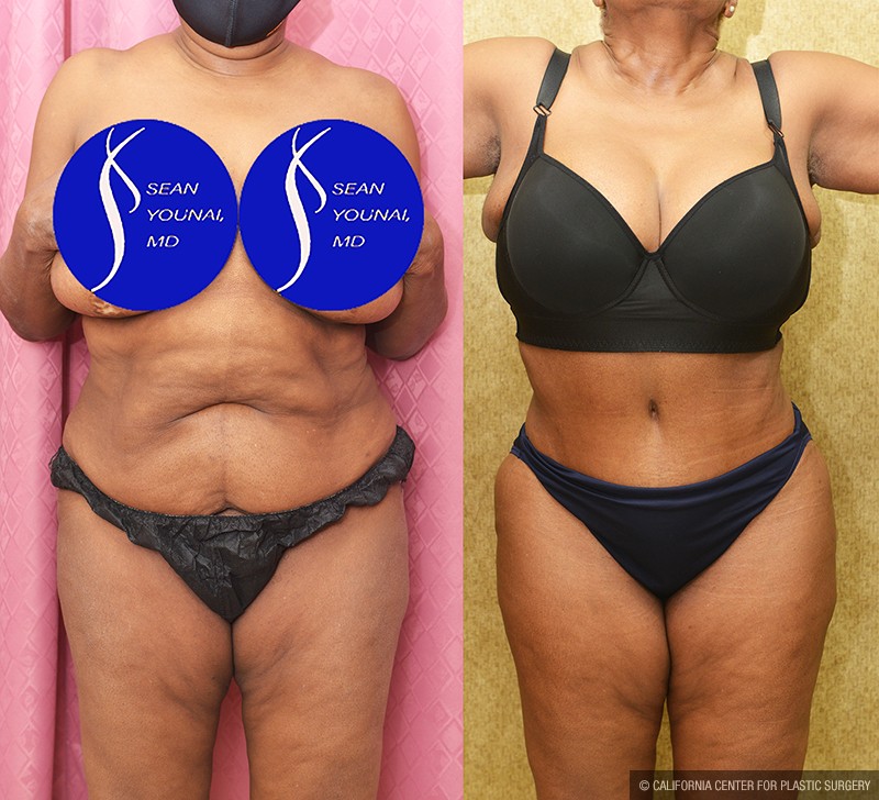 African American Tummy Tuck (Abdominoplasty) Before & After Patient #14695