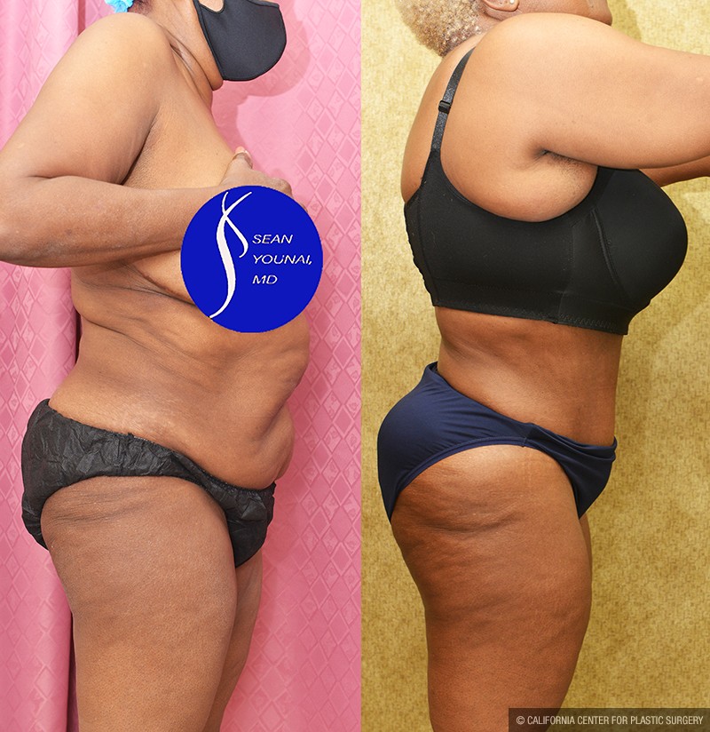 African American Tummy Tuck (Abdominoplasty) Before & After Patient #14695