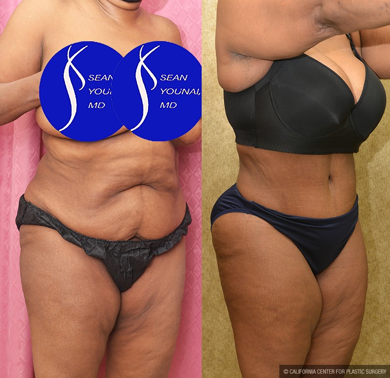 African American Tummy Tuck (Abdominoplasty) Before & After Patient #14695