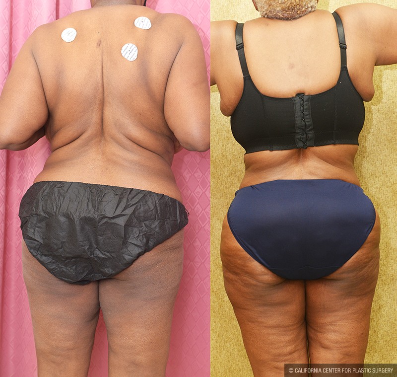 African American Tummy Tuck (Abdominoplasty) Before & After Patient #14695