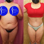 Tummy Tuck (Abdominoplasty) Medium Size Before & After Patient #14697