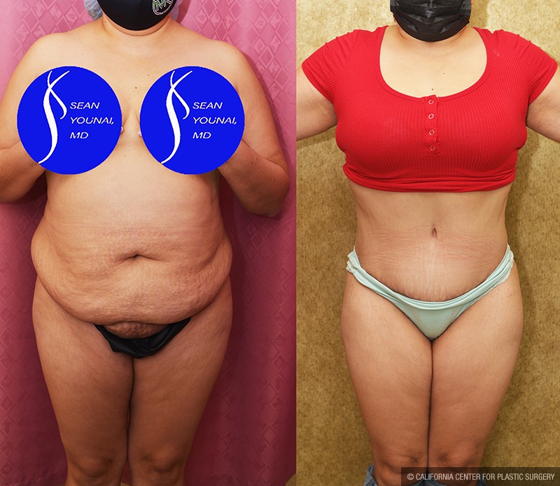 Tummy Tuck (Abdominoplasty) Medium Size Before & After Patient #14697