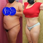 Tummy Tuck (Abdominoplasty) Medium Size Before & After Patient #14697