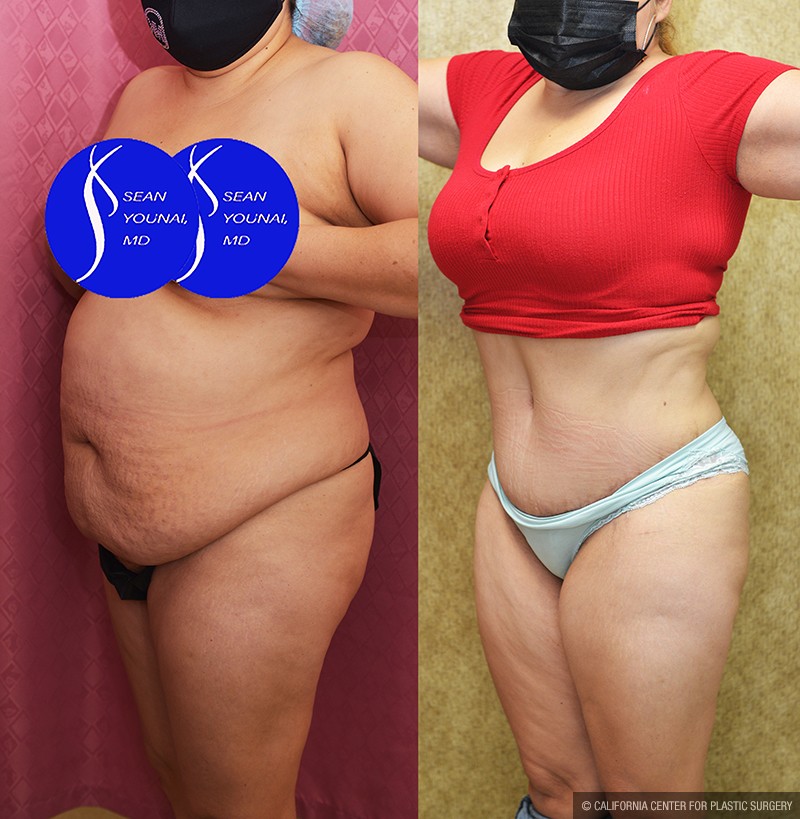 Tummy Tuck (Abdominoplasty) Medium Size Before & After Patient #14697