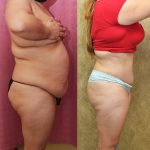 Tummy Tuck (Abdominoplasty) Medium Size Before & After Patient #14697