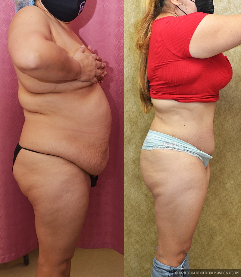 Tummy Tuck (Abdominoplasty) Medium Size Before & After Patient #14697