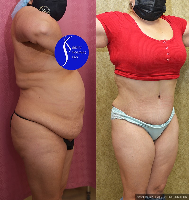 Tummy Tuck (Abdominoplasty) Medium Size Before & After Patient #14697