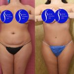 Tummy Tuck (Abdominoplasty) Medium Size Before & After Patient #14698