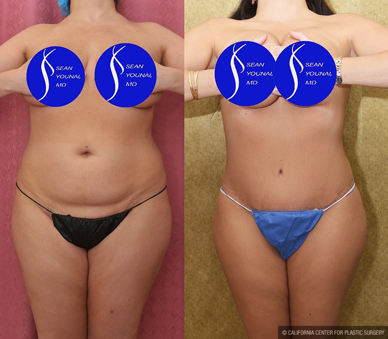 Tummy Tuck (Abdominoplasty) Medium Size Before & After Patient #14698
