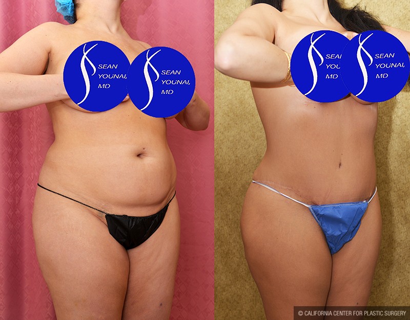Tummy Tuck (Abdominoplasty) Medium Size Before & After Patient #14698