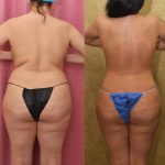 Tummy Tuck (Abdominoplasty) Medium Size Before & After Patient #14698